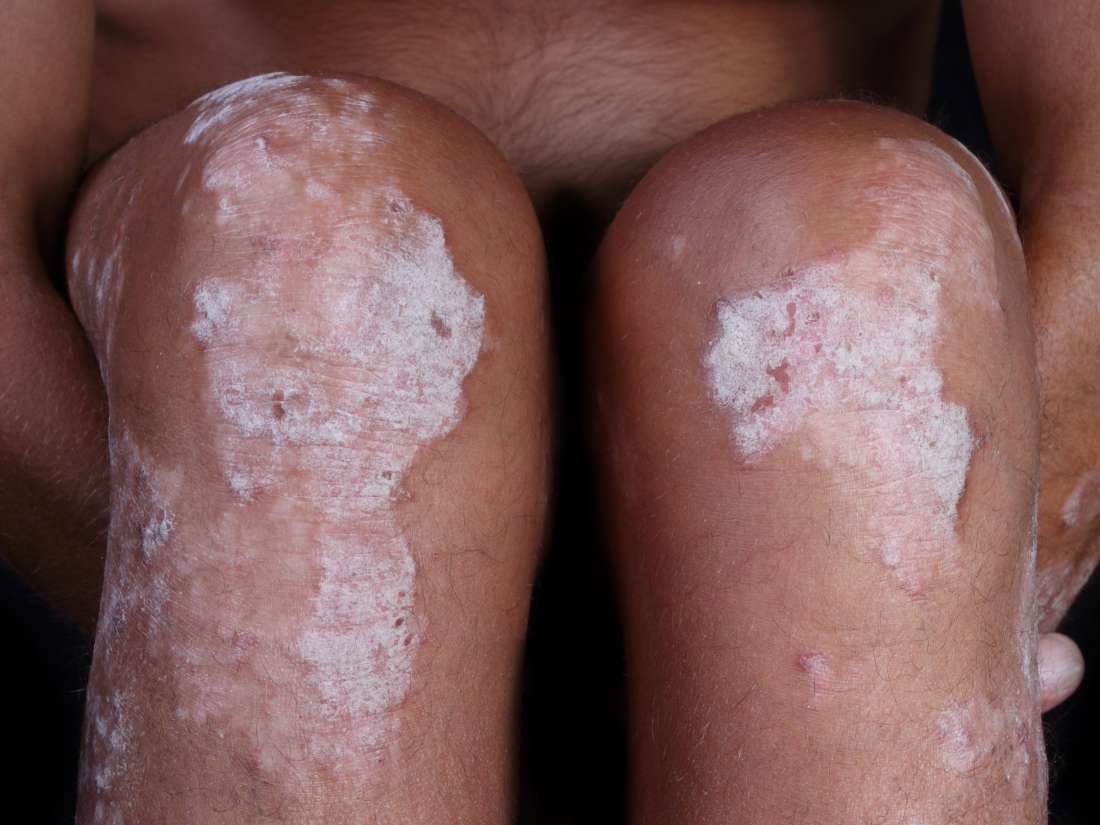 Psoriasis on black skin Pictures, symptoms, and treatment