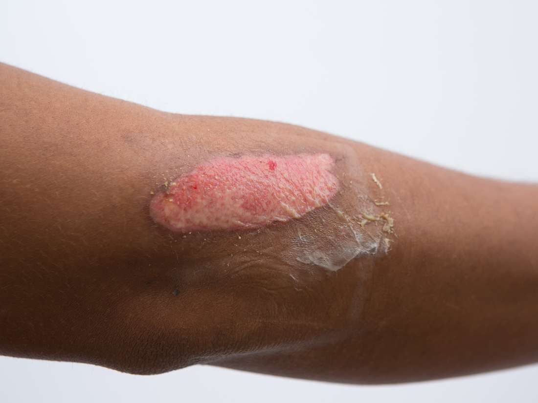 Second degree Burn Causes Symptoms And Treatment