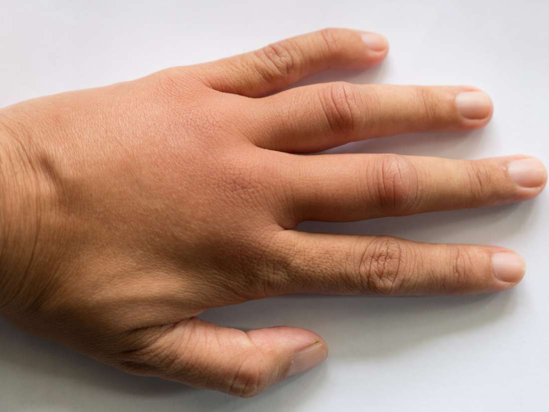 What Are The Causes Of Swollen Hands 