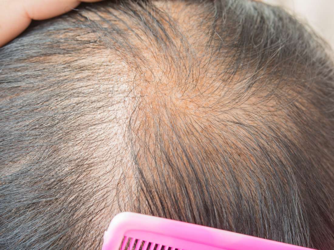 Thinning Hair Causes Types Treatment And Remedies - 