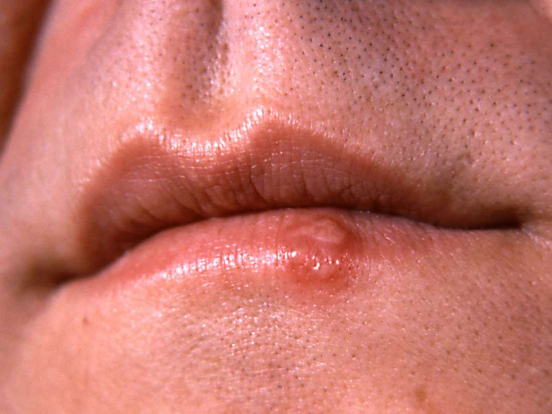 Oral venereal disease mouth penis