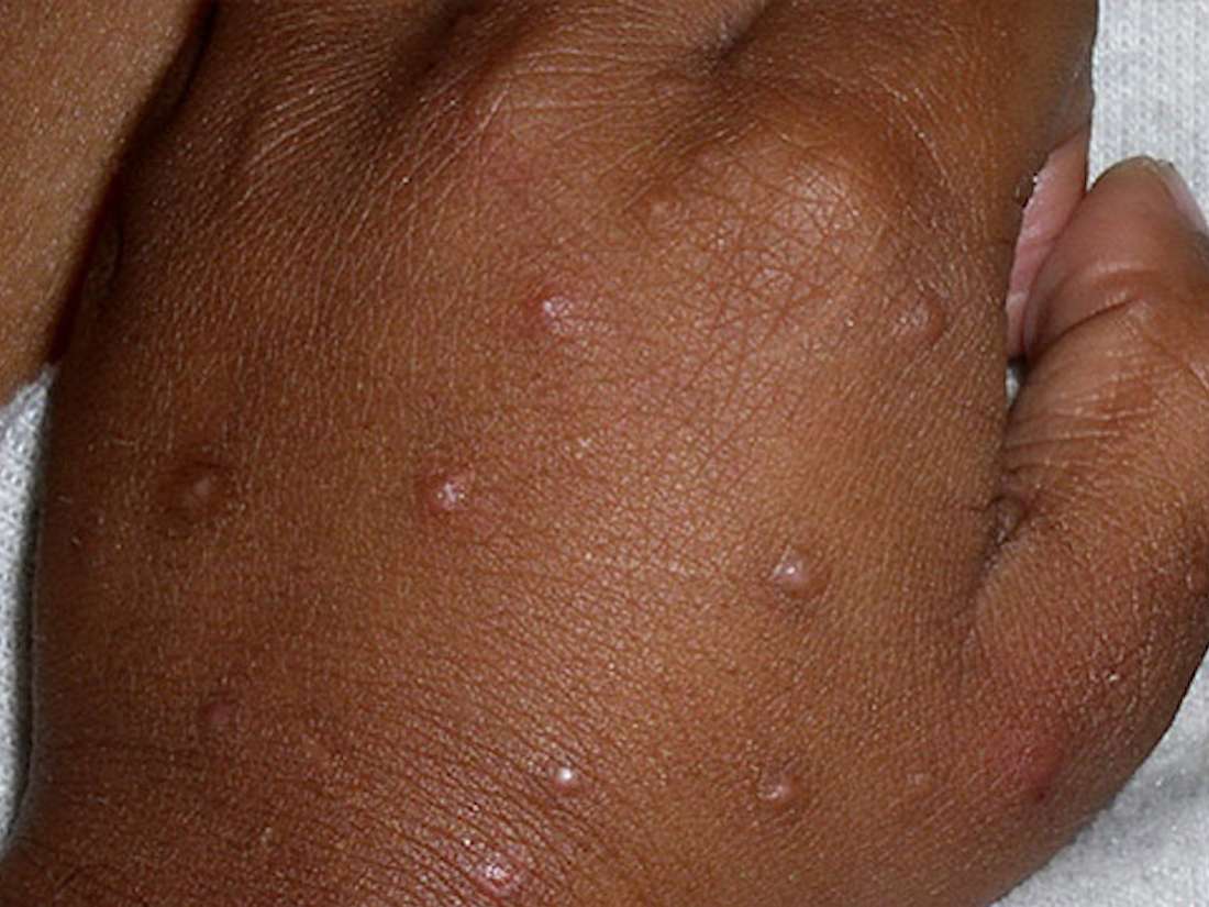 which-vitamin-deficiency-causes-white-spots-on-skin-ayu-health