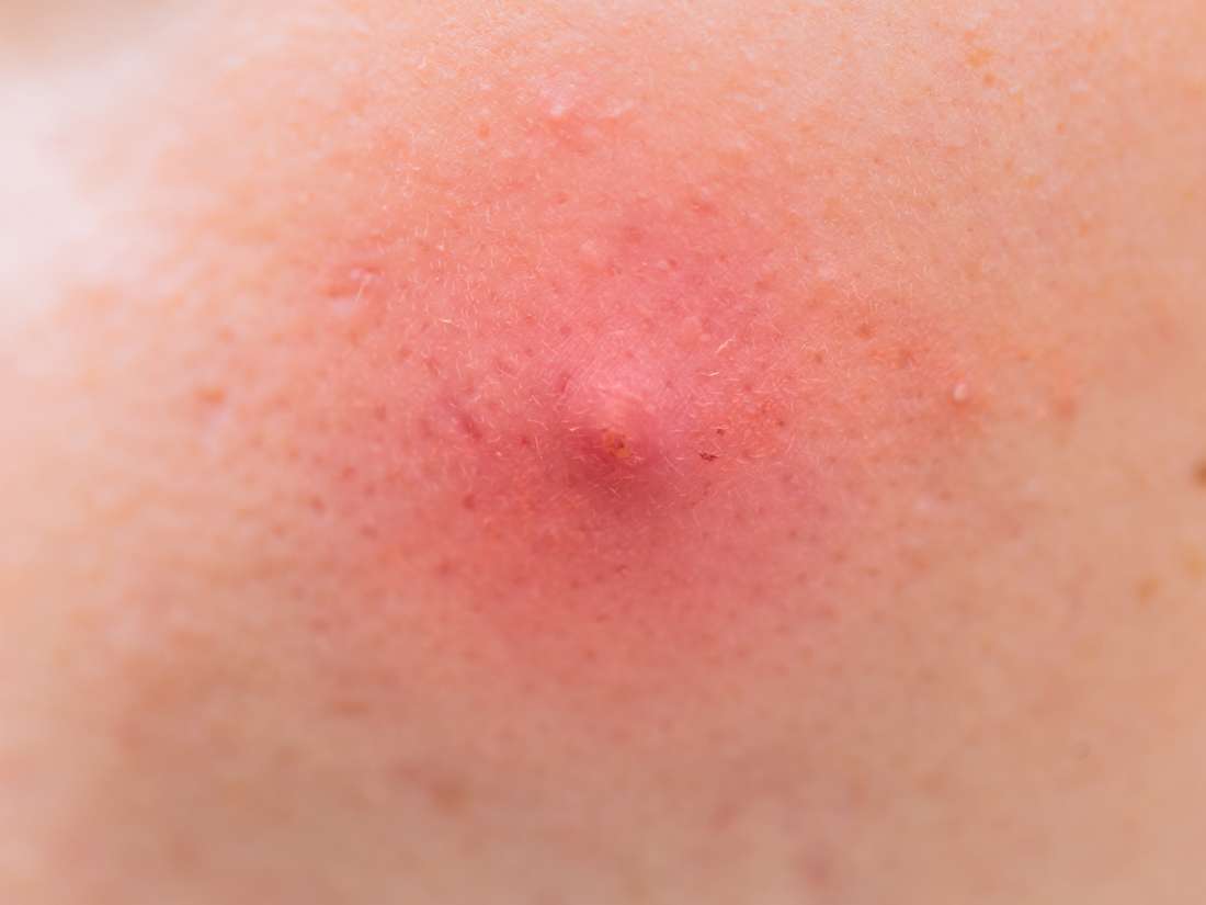 Armpit pimple: Types, causes, and treatments