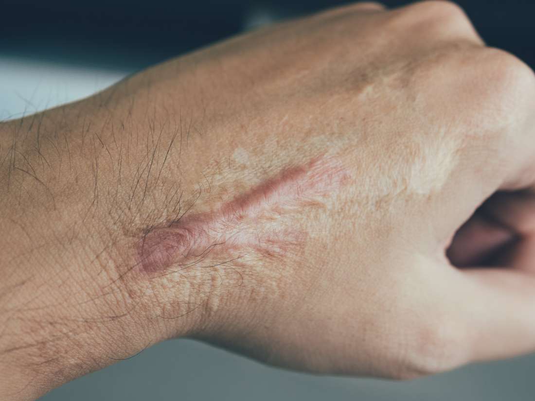 Ultrasound Scar Tissue Treatment at Troy Braxton blog