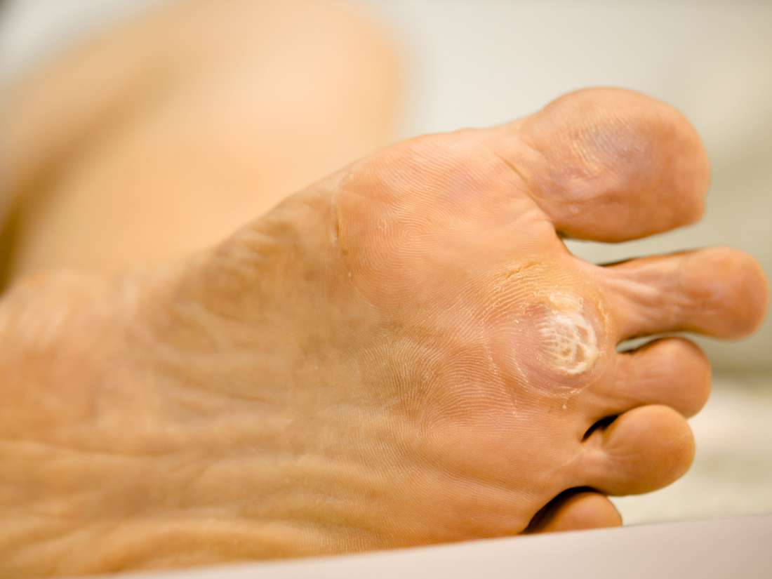 Plantar Warts Symptoms Causes And Treatment