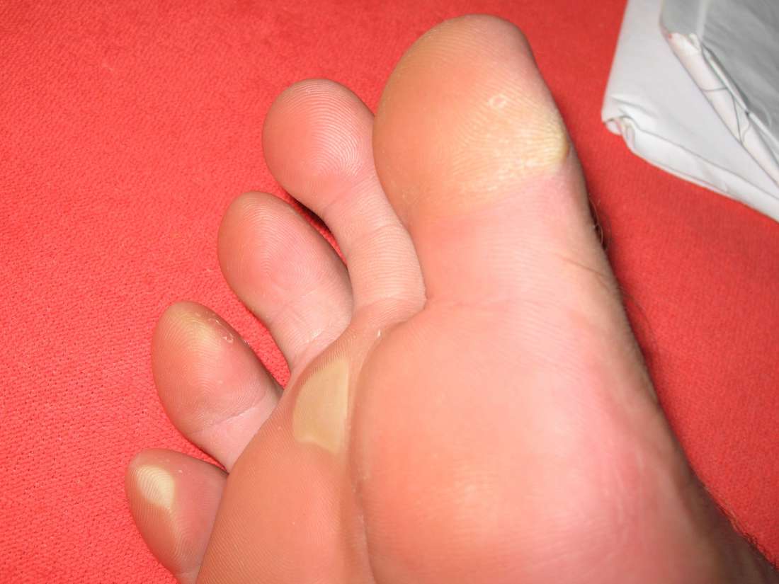 yellow-feet-6-potential-causes