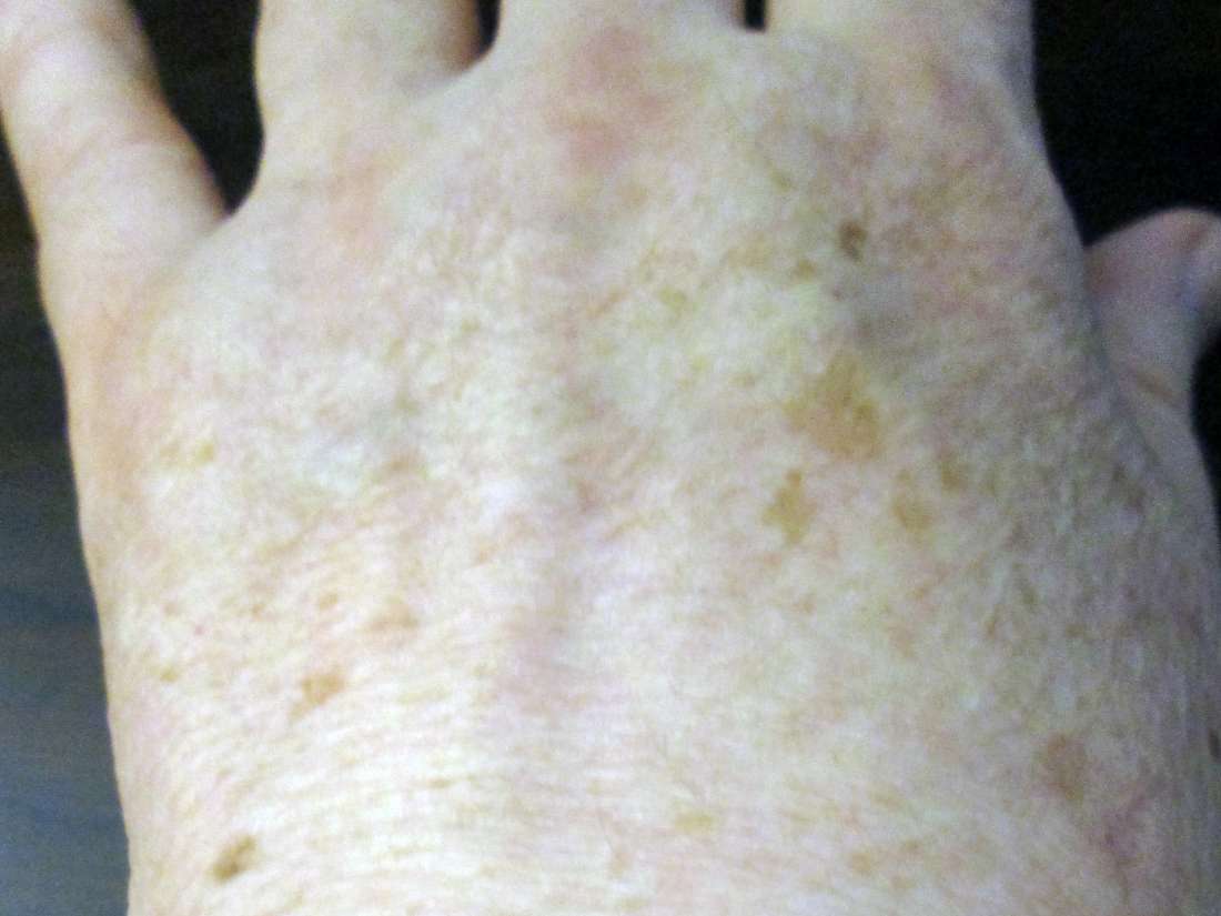 What to do about pigmentation
