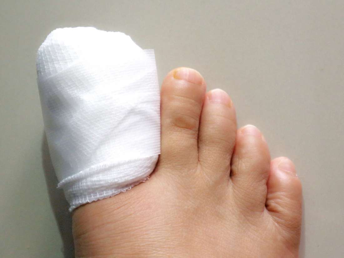 how-long-after-ingrown-toenail-surgery-can-i-exercise-exercisewalls