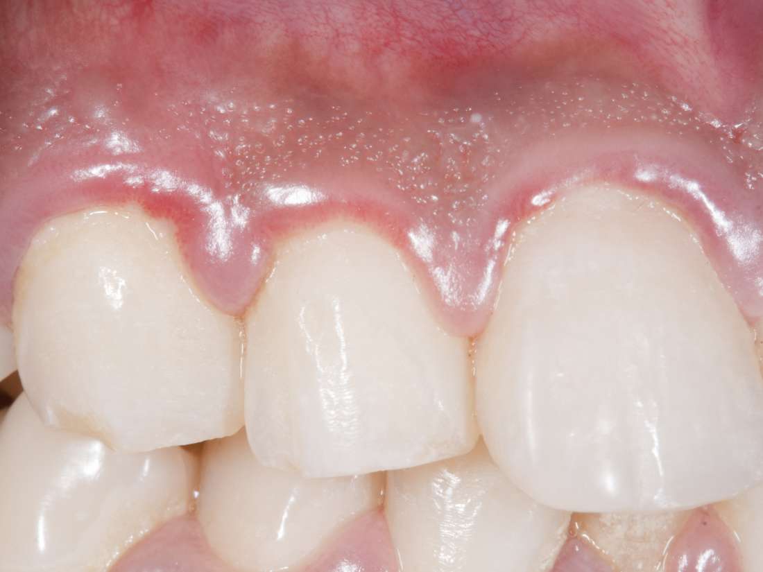 Swollen Gums Causes Treatments And Home Remedies - 