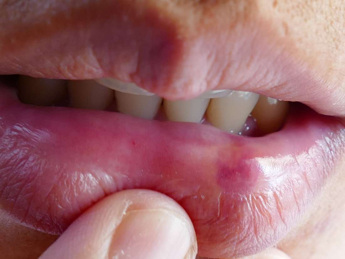 Busted Lip 9 Treatments And Home Remedies 