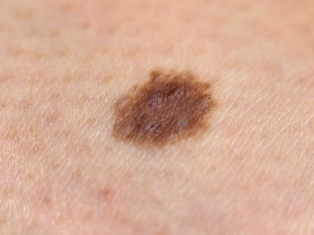 new-moles-and-what-to-look-out-for-medical-news-corner