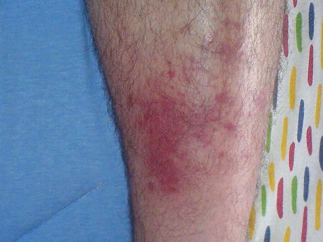 What to know about cellulitis from bug bites
