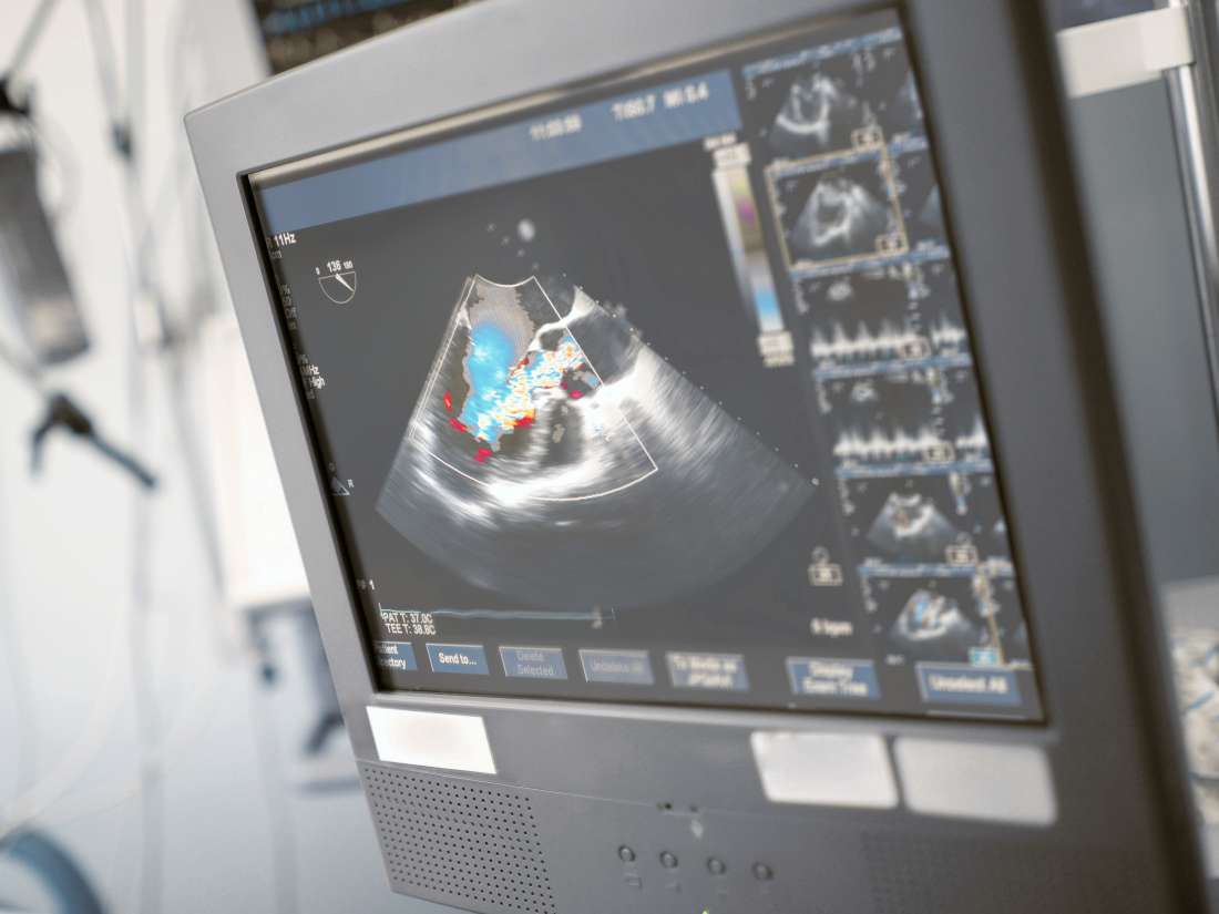 what-is-an-echocardiogram-uses-procedure-and-results