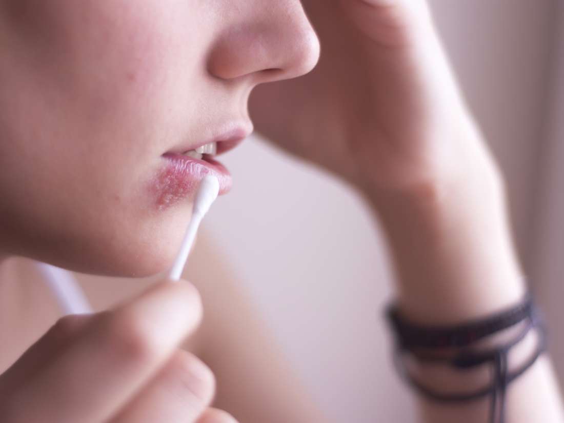 Preventing herpes infections: Study offers new insights