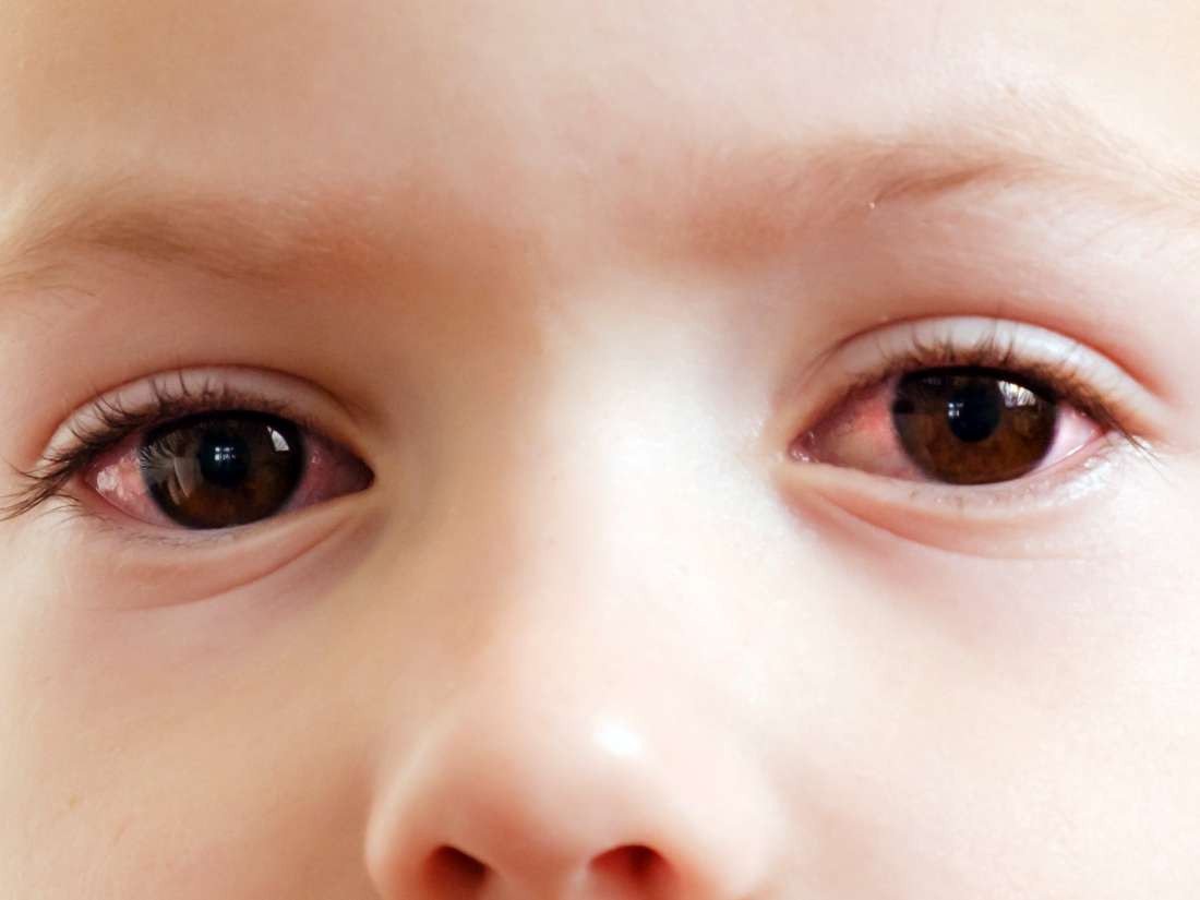 pink-eye-in-toddlers-symptoms-diagnosis-and-treatment