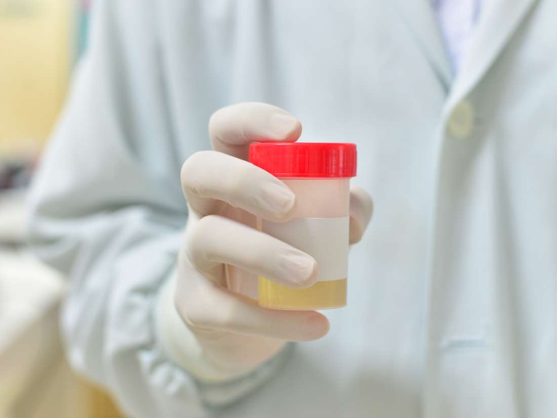 prostate-cancer-home-urine-test-could-revolutionize-diagnosis