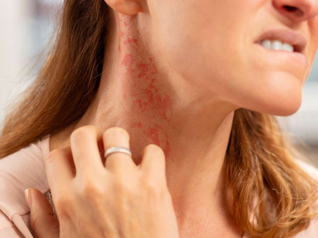 8 types of itchy rash